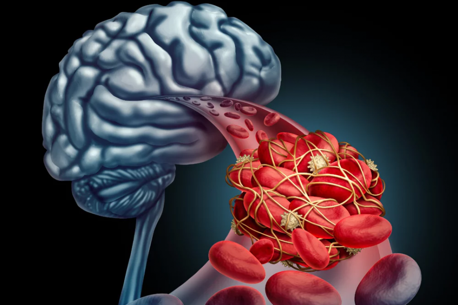 brain blood image